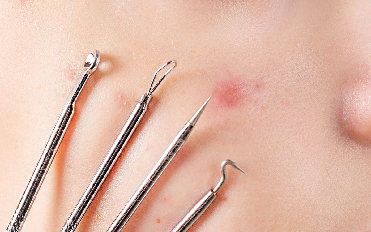 Лікування акне та постакне – дерматолог клініки VIA Derm