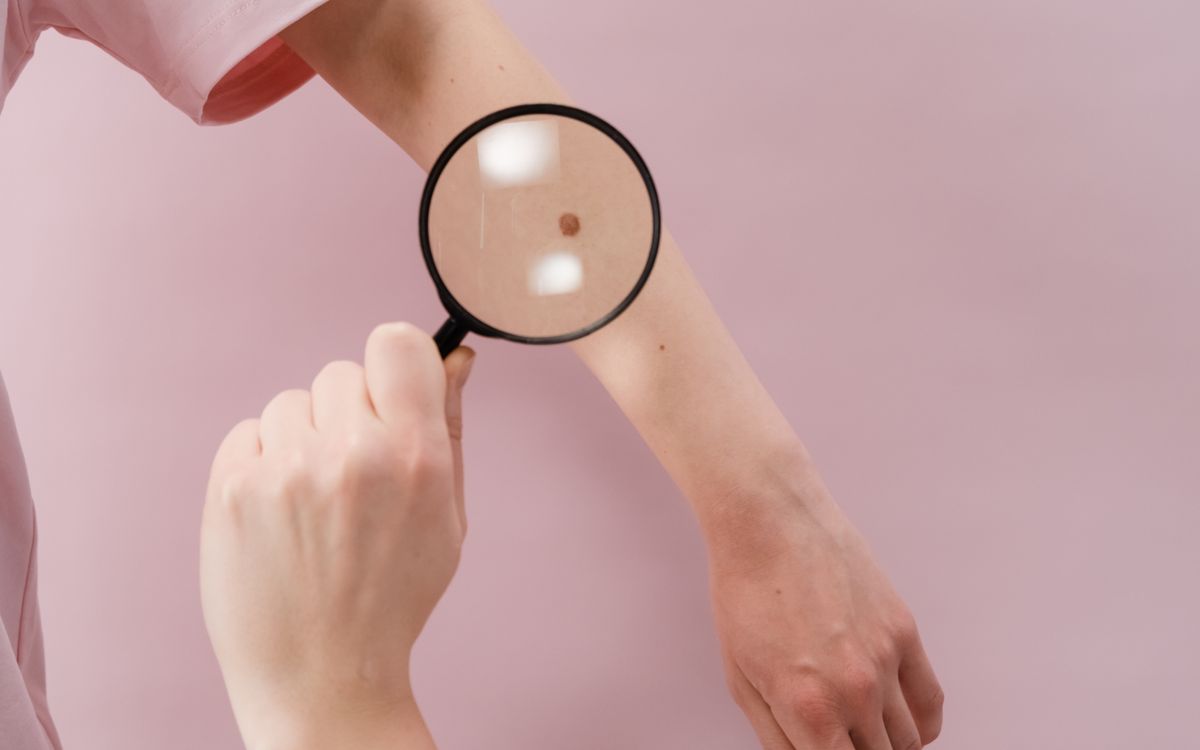 Трихоскопія – діагностика волосся та шкіри голови у VIA Derm