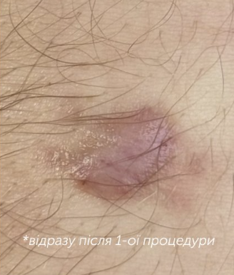 Після — Консультація дерматовенеролога